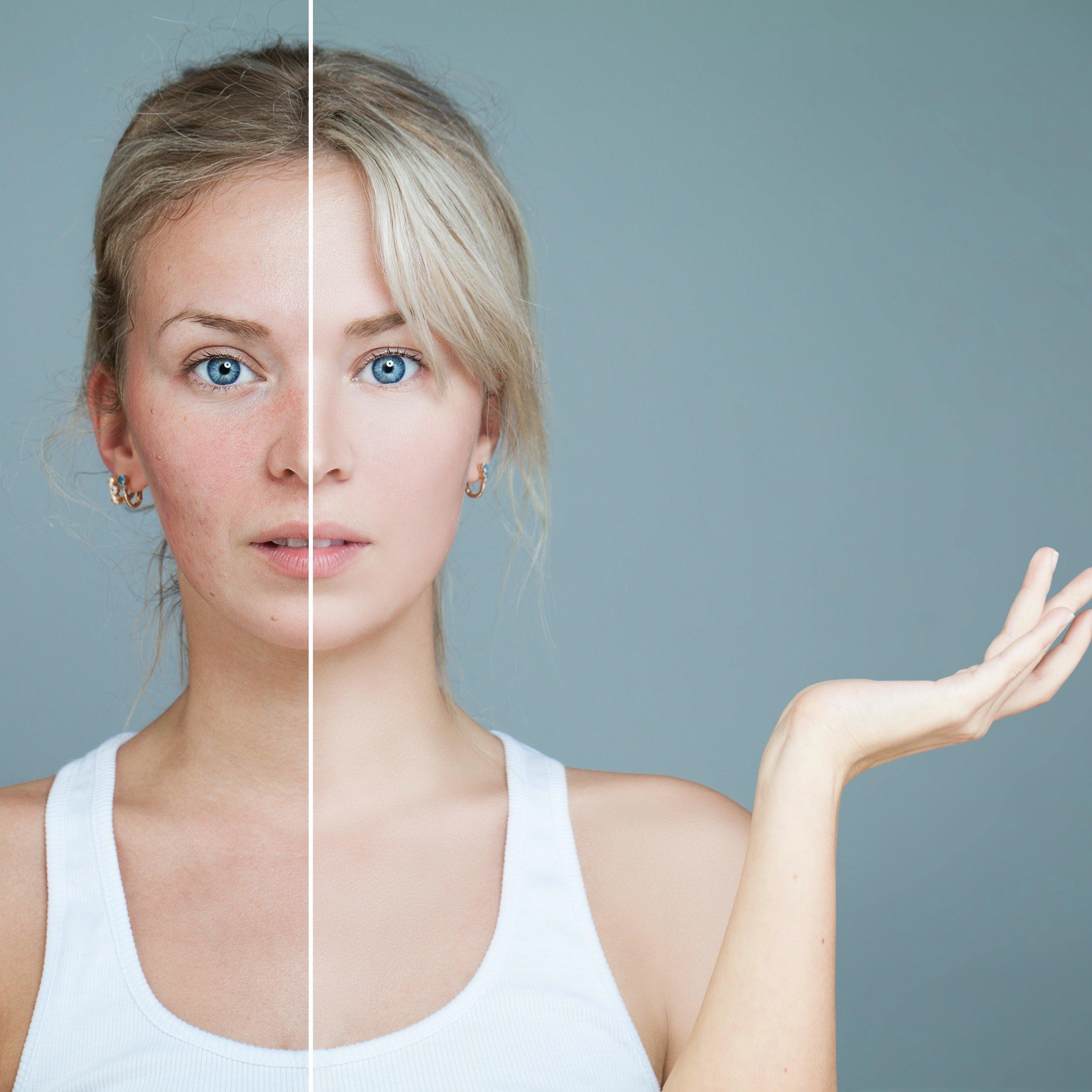 Redness - Skin Vitality Medical Clinic