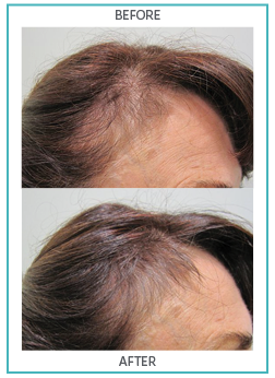 Hair Nourishment Supplements