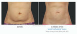 CoolSculpting® Boxing Day Offer