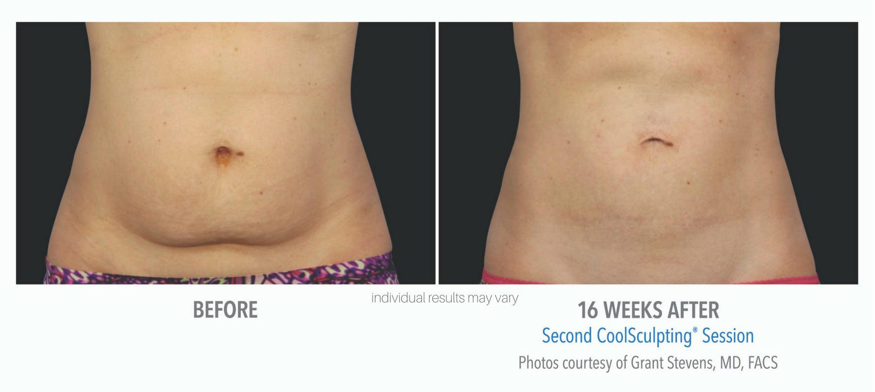 CoolSculpting® Boxing Day Offer