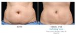 CoolSculpting® Boxing Day Offer