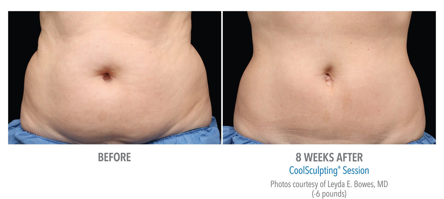 CoolSculpting® Boxing Day Offer