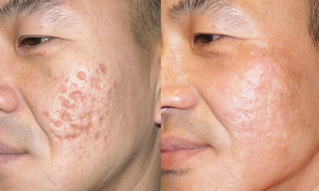 DermaPen4 MicroNeedling Boxing Day Offer