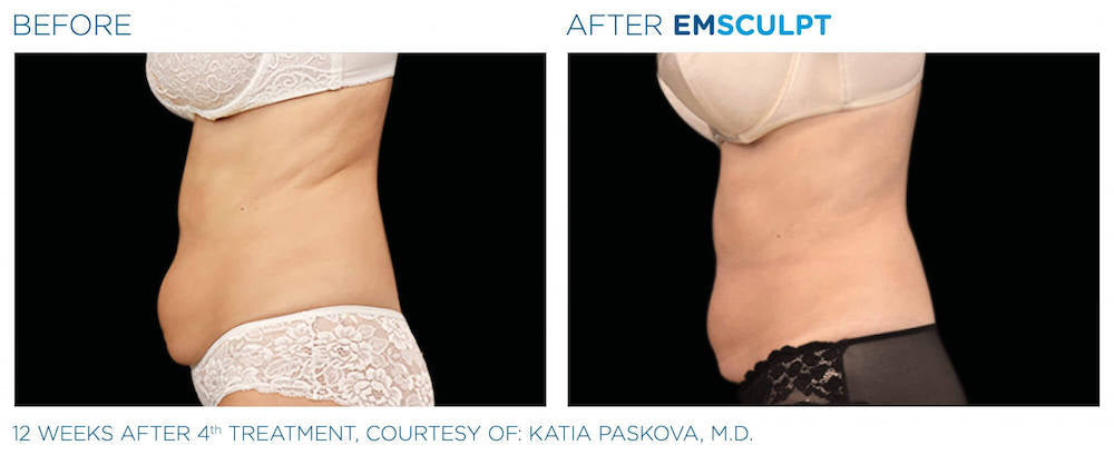 $1400 Gift Certificate for 4 EMSculpt Sessions
