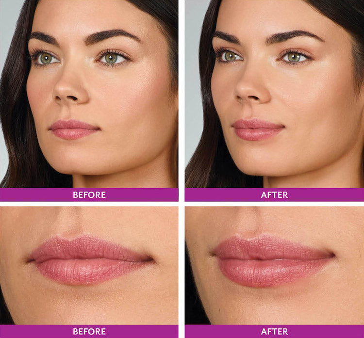 $500 Gift Certificate for 1 Juvederm Syringe