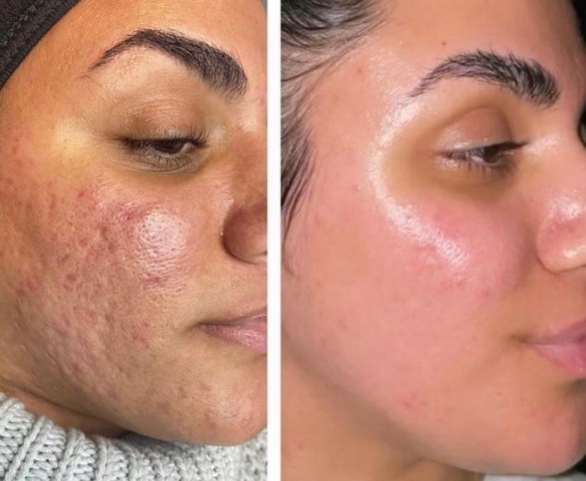 $700 Gift Certificate for Morpheus8 Face + Neck Session