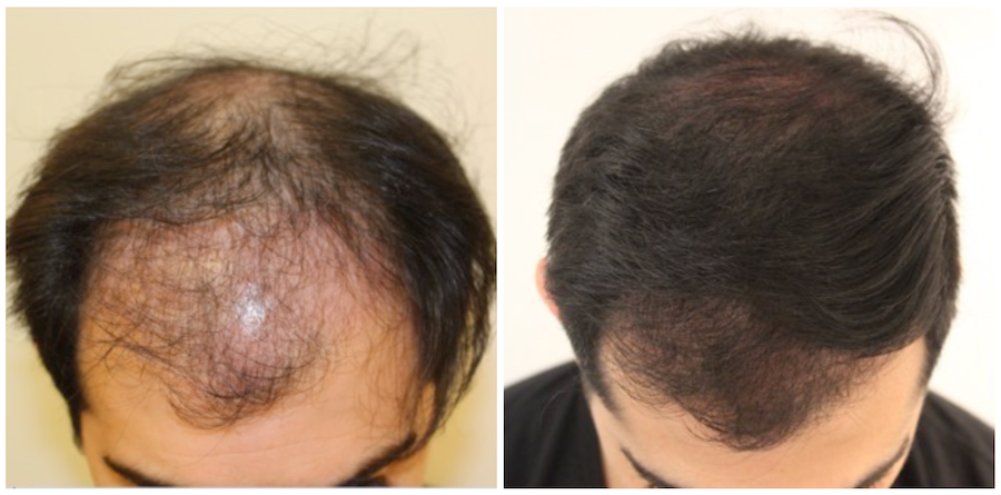 PRP Hair Restoration Cyber Monday Offer