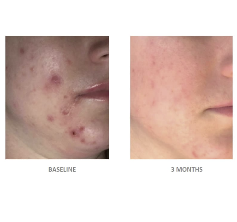 Vivier Acne Treatment System