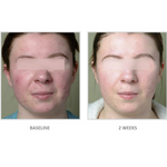 Vivier Acne Treatment System