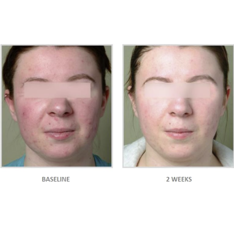 Vivier Acne Treatment System