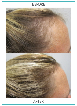 Hair Nourishment Supplements