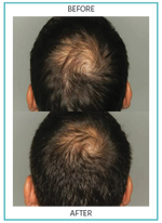 Hair Nourishment Supplements