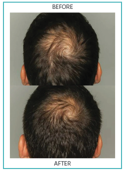 Hair Nourishment Supplements