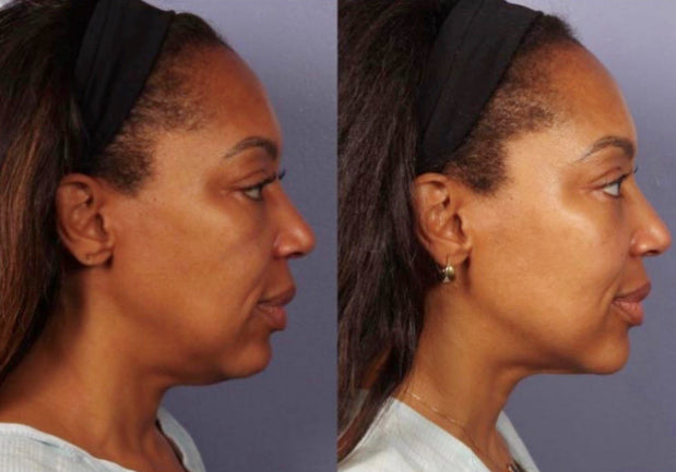 $700 Gift Certificate for Morpheus8 Face + Neck Session
