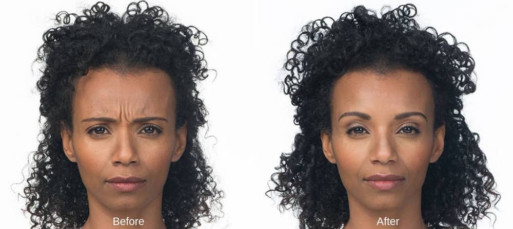 $800 Gift Certificate for 100 Units of Botox