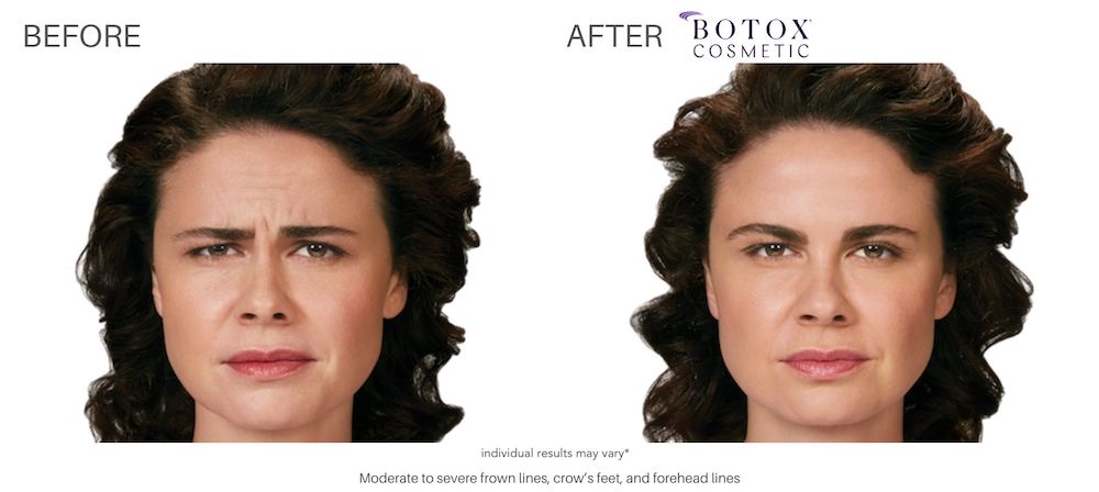 $800 Gift Certificate for 100 Units of Botox