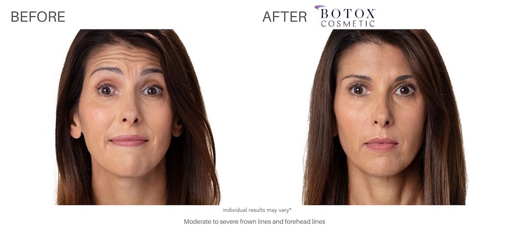 $800 Gift Certificate for 100 Units of Botox