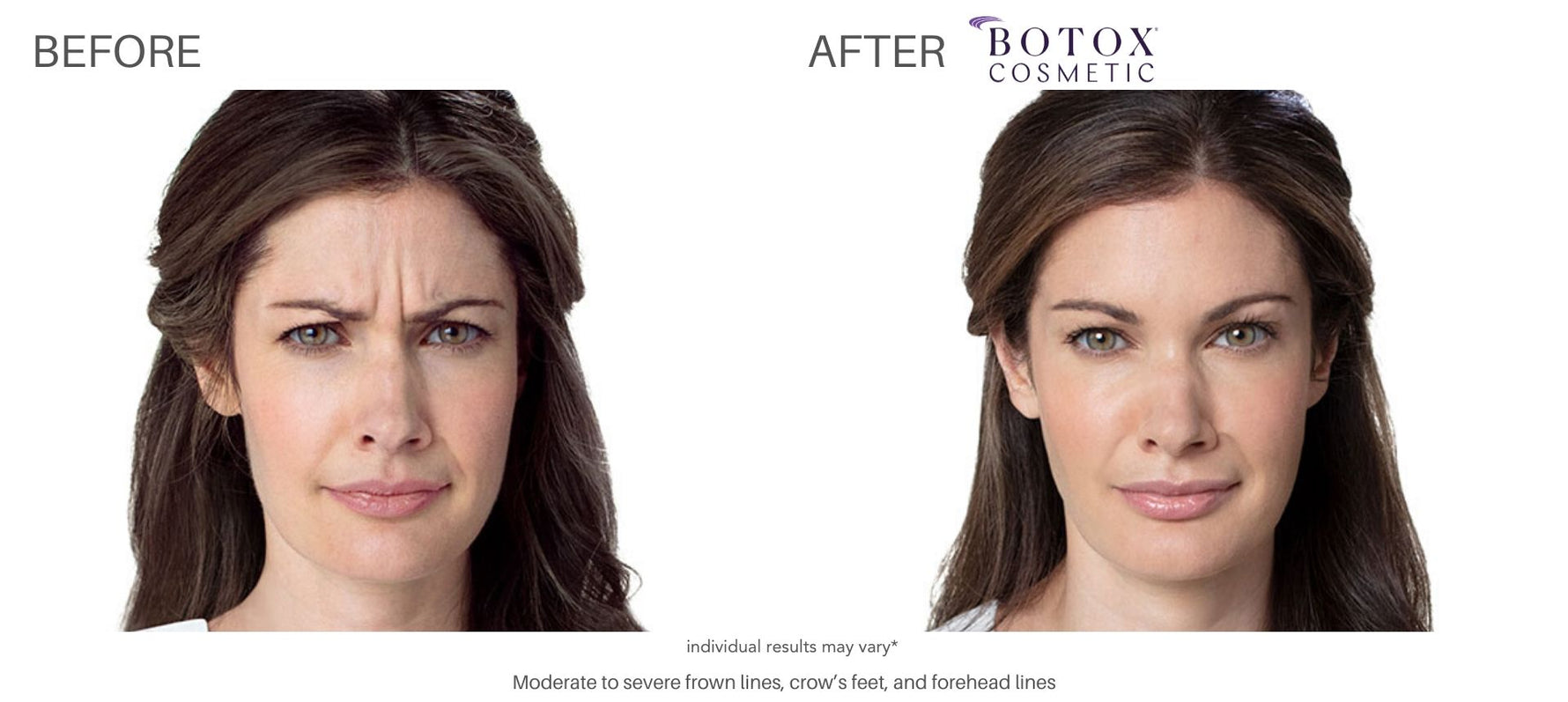 50 Units of Botox + 10 FREE - Boxing Day Offer