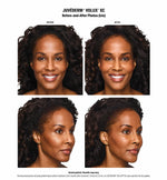 $500 Gift Certificate for 1 Juvederm Syringe