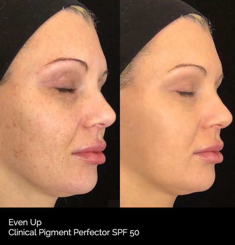 Even Up® Pigment Perfector SPF 50