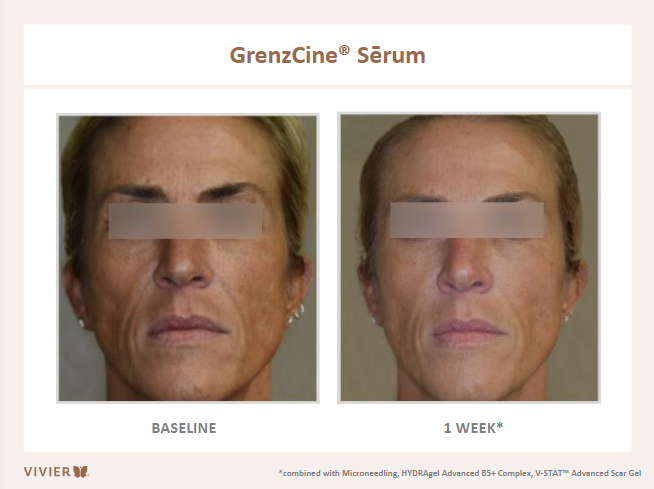 GrenzCine Serum